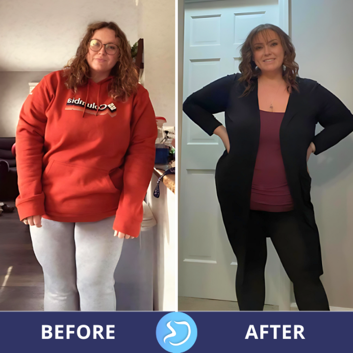 Before and After Photos - Gastric Sleeve in Tijuana Mexico