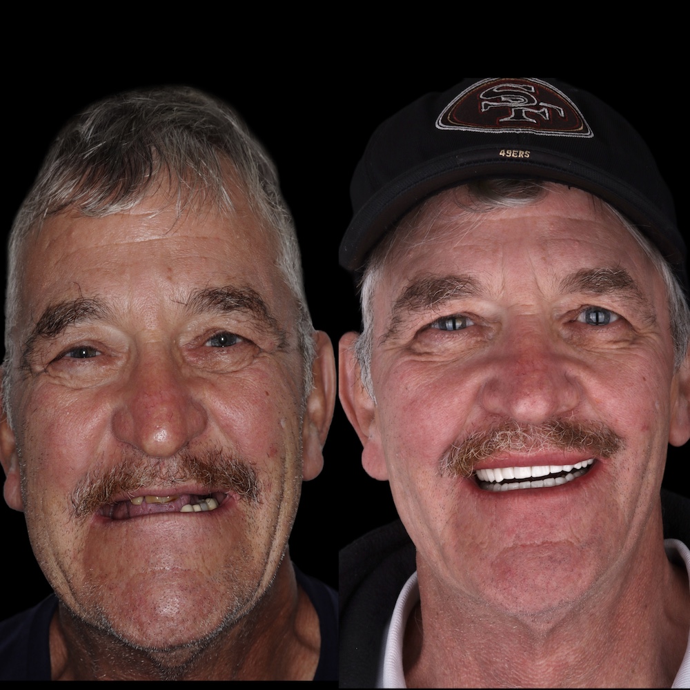 man before and after dental implants