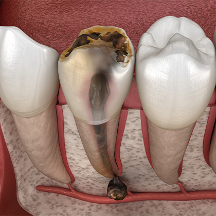 Root canal infection