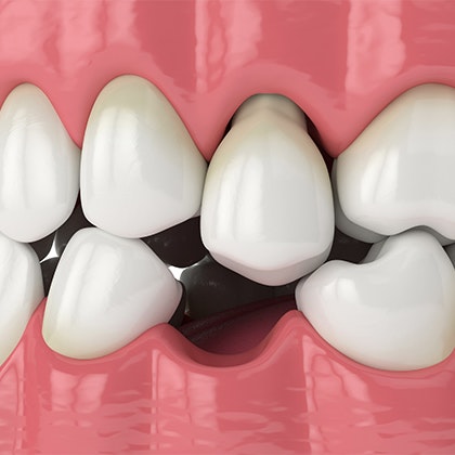 Missing tooth