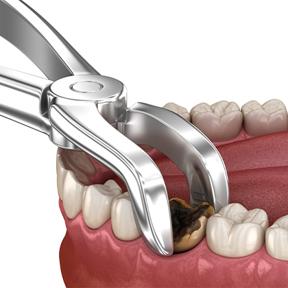 Tooth being extracted