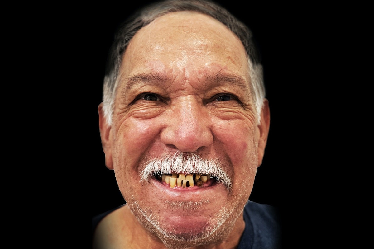 man with worn and missing teeth