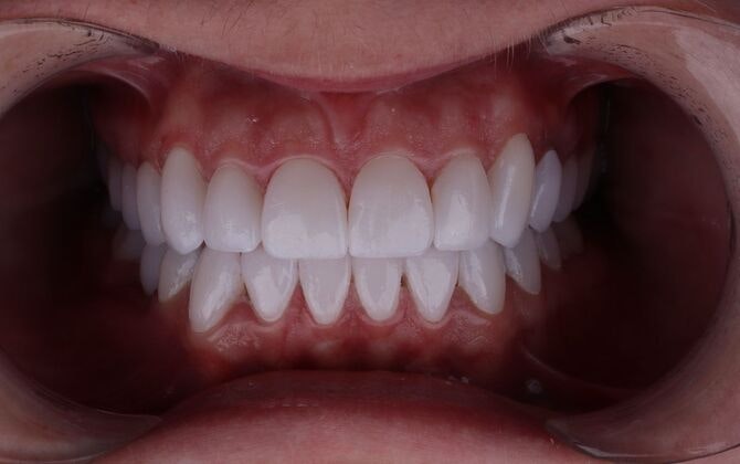 smile after veneers