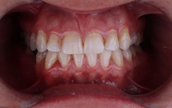 smile before veneers