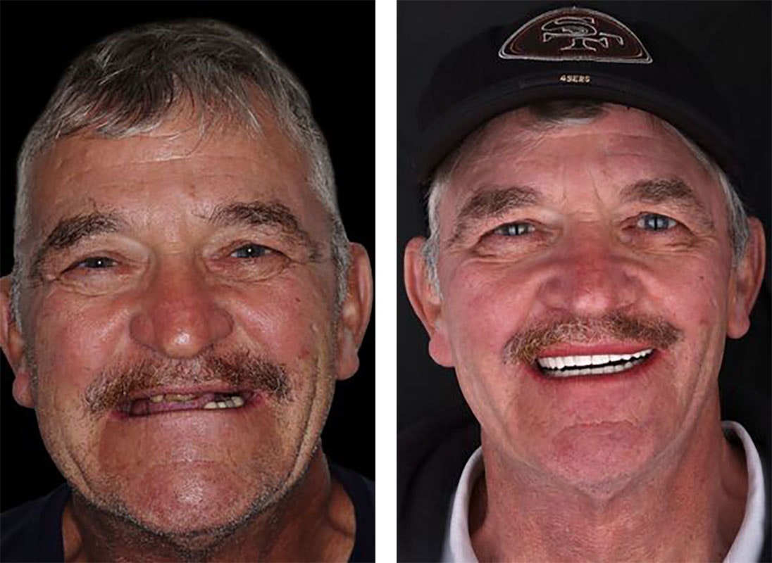 Before and after our patient restores his mouth with six dental implants