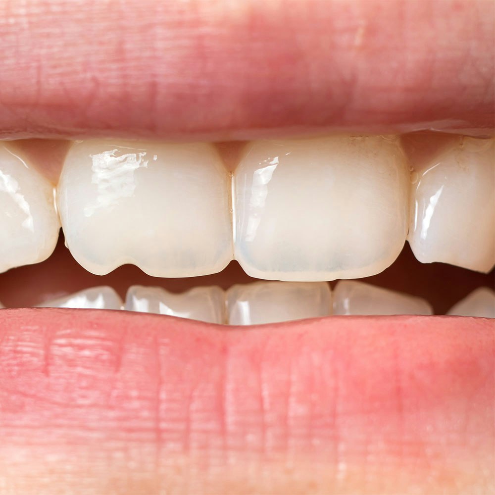 Close-up of chipped tooth