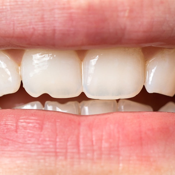 Close-up of chipped tooth