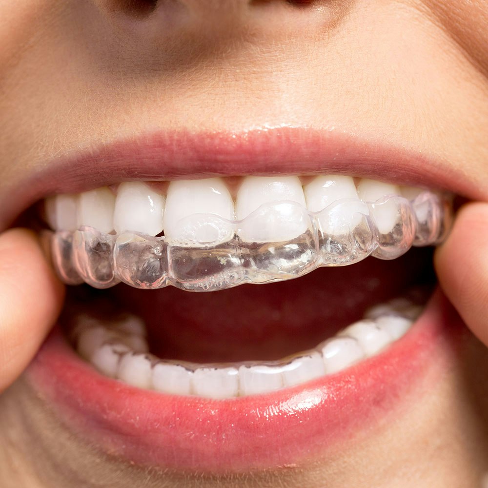 Close-up of person placing Invisalign