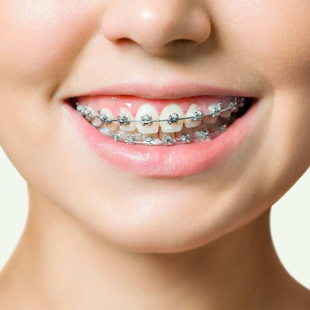Close-up-of-person-smiling-with-braces