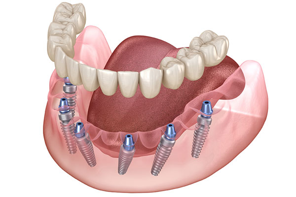 All-on-6 restoration