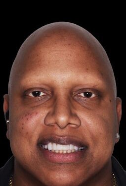 Uneven smile before veneers