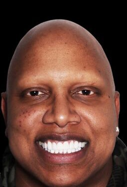 Confident smile after veneers