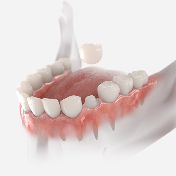 dental crowns