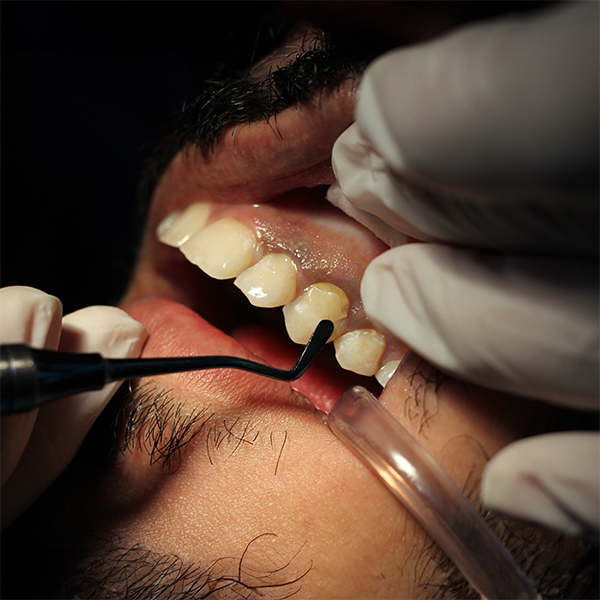 Close-up of dentist applying a bonding agent to tooth