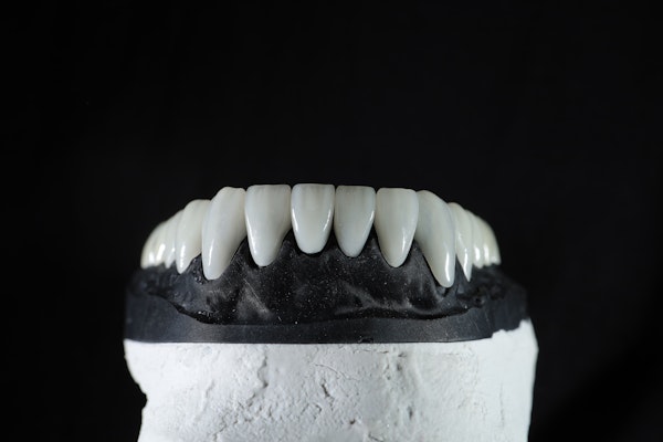 veneers on a dental model