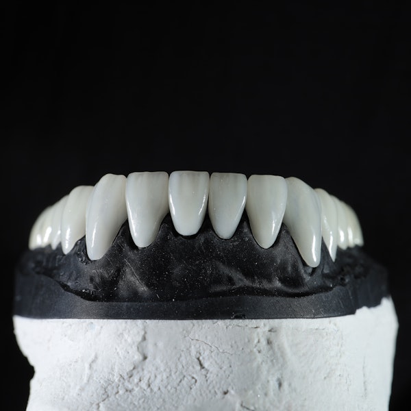 veneers on a dental model