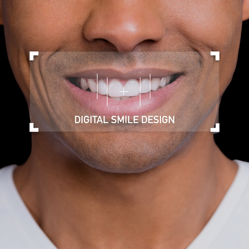 smile design