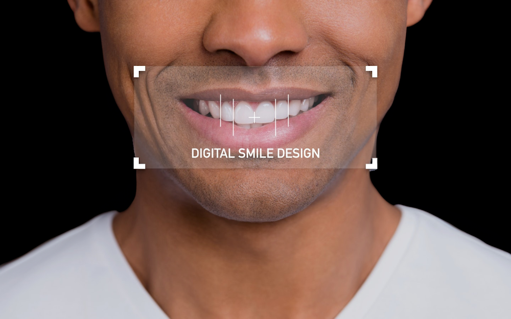 smile design