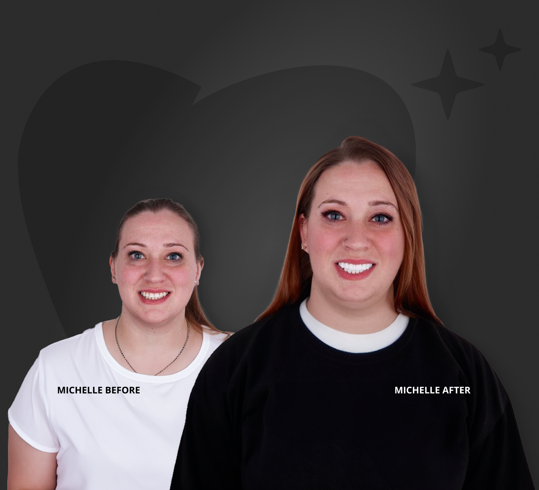 Michelle before and after veneers