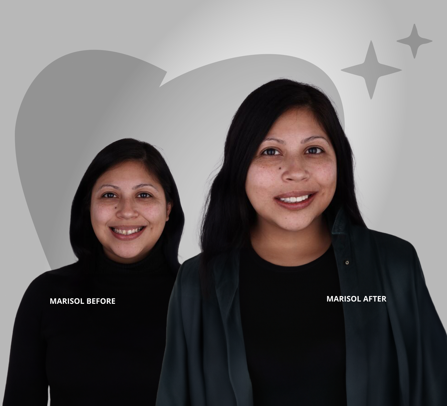Marisol before and after veneers