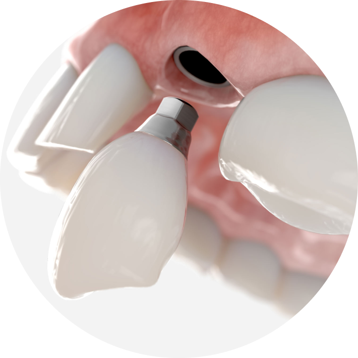 3D rendering of a dental implant