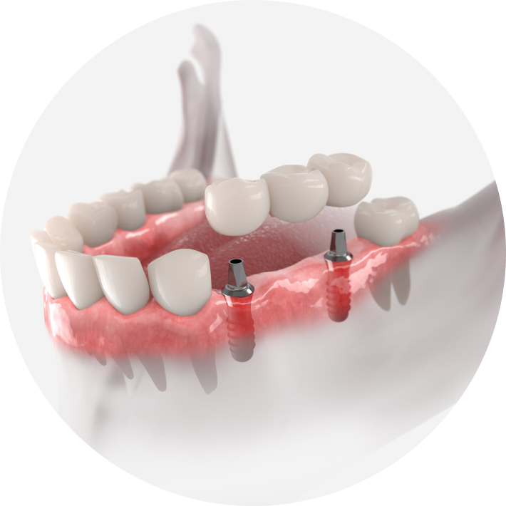3D rendering of a dental bridge