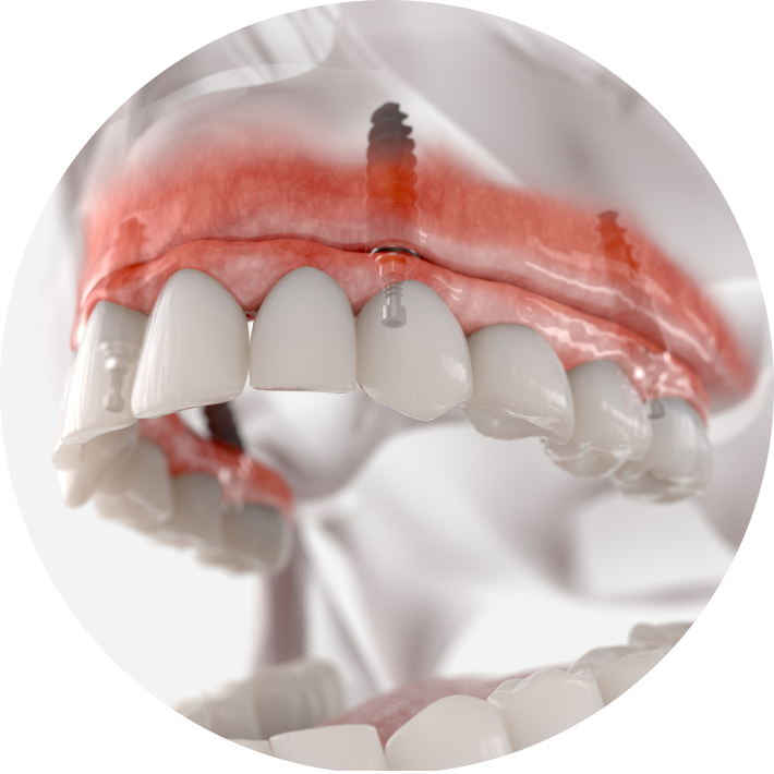3D rendering of All-on-4 dental implants