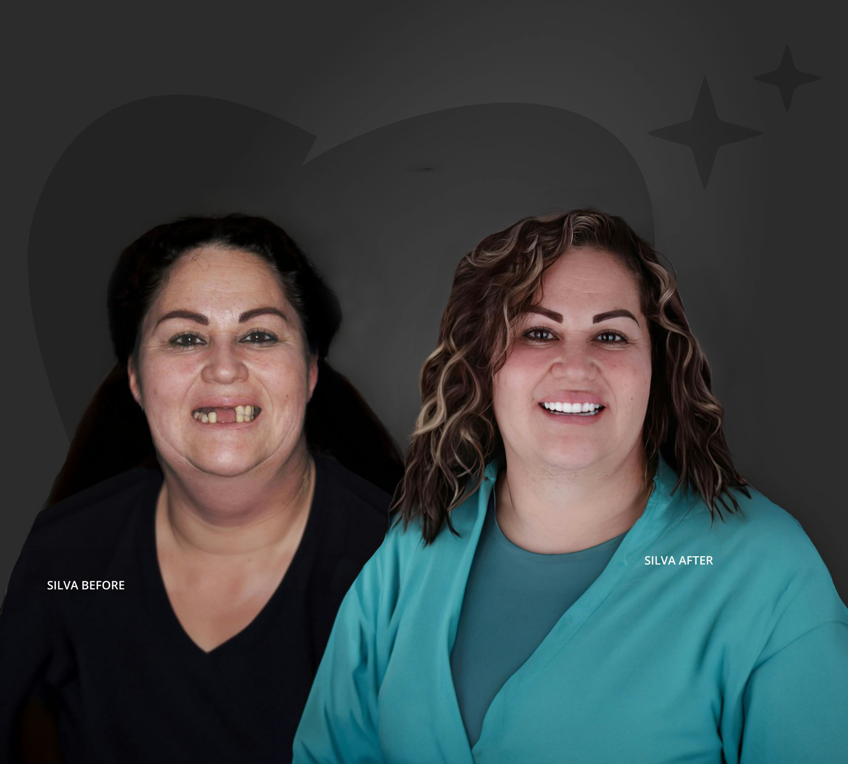 Silva before and after implants