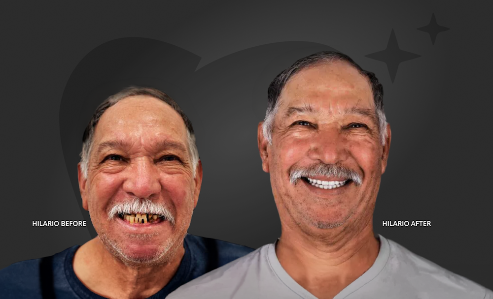 Hilario before and after implants