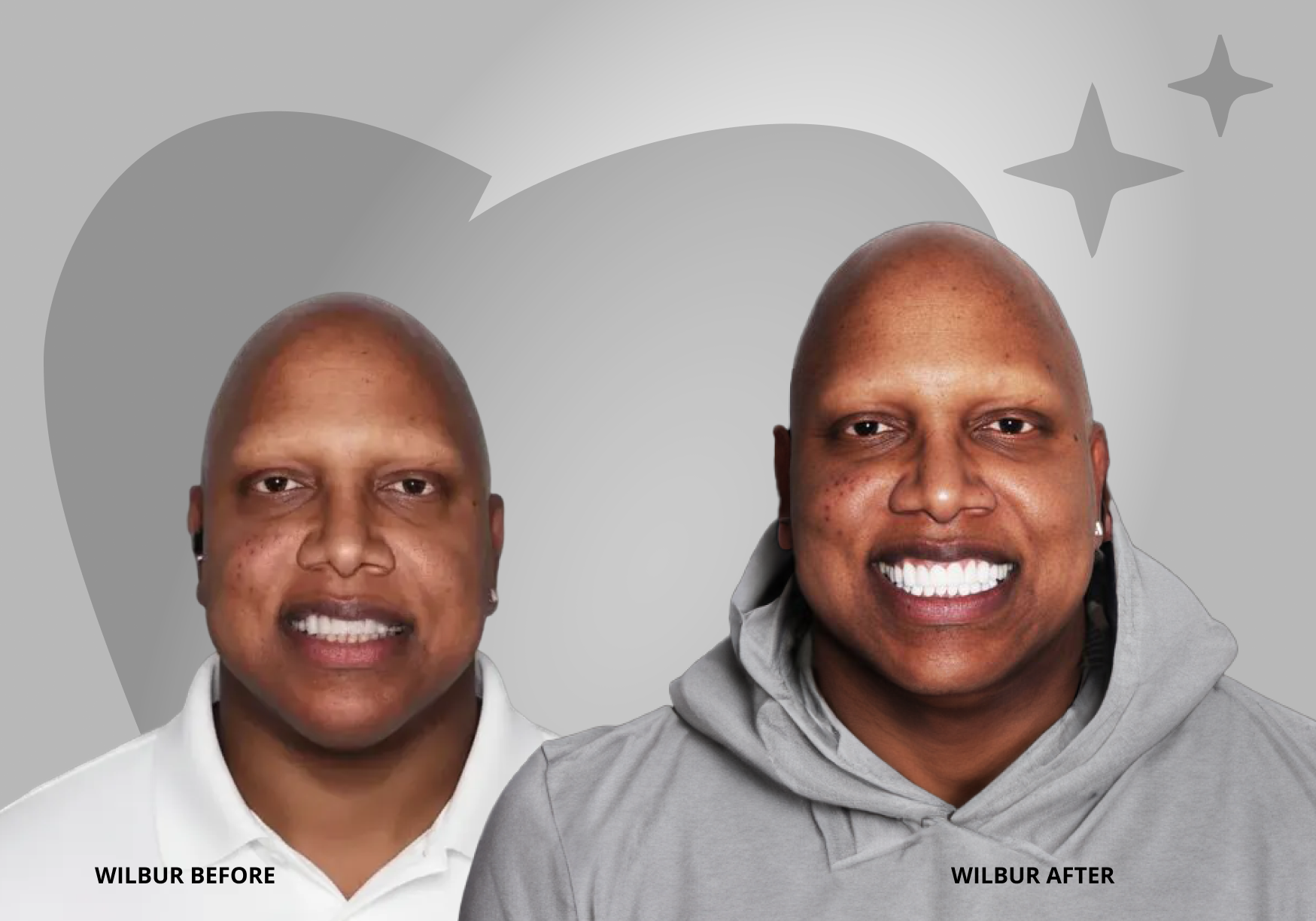 Wilbur before and after veneers