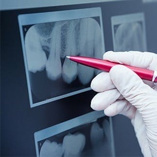 pen pointing to x-ray