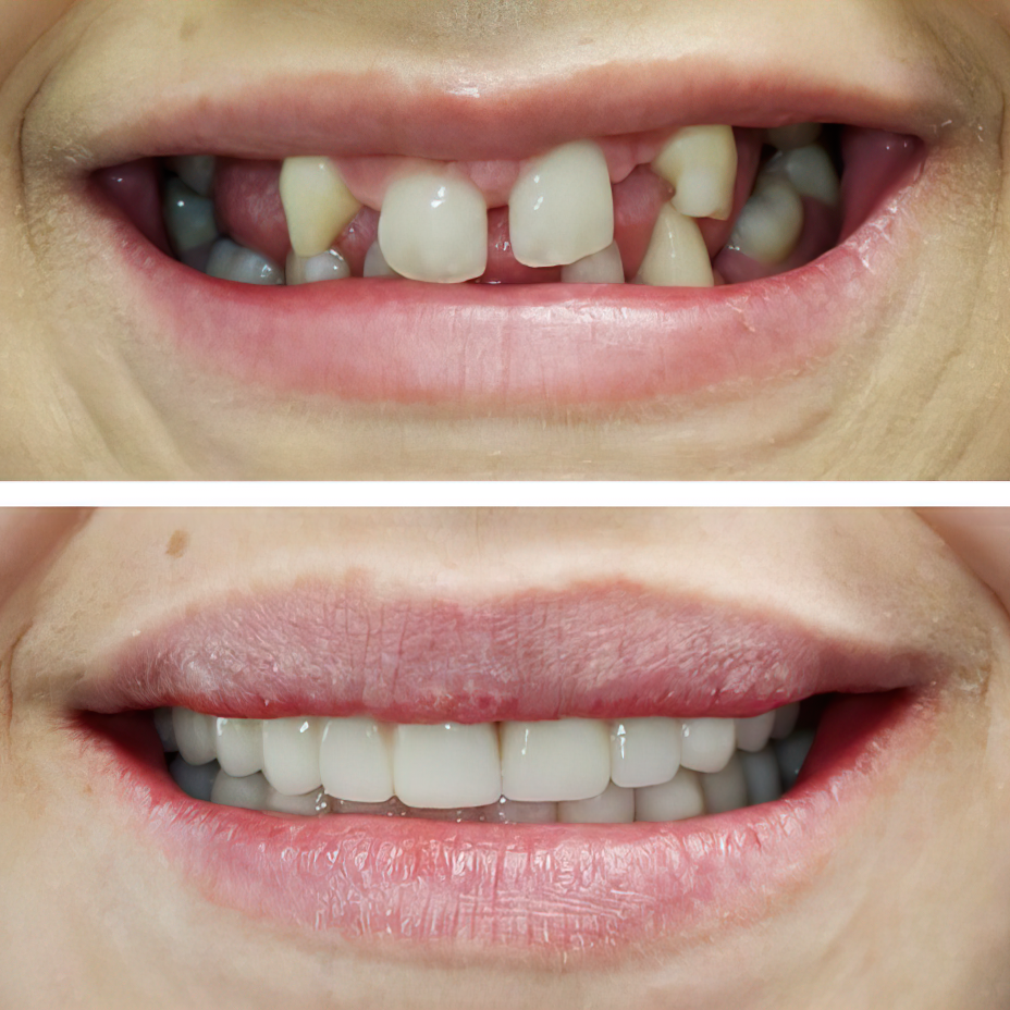 Dental Implants Littleton, CO Implant Dentistry Advanced Dentistry