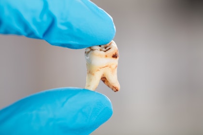 Decayed tooth