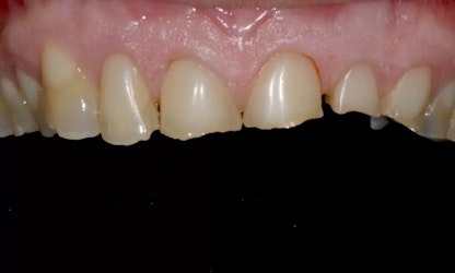 Full Mouth Rehabilitation