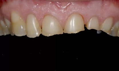 Full Mouth Rehabilitation