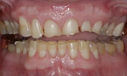 Prototype Provisional Temporaries