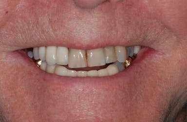 Full Mouth rehabilitation