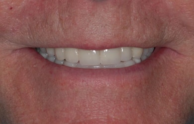 Full Mouth Rehabilitation Rehab