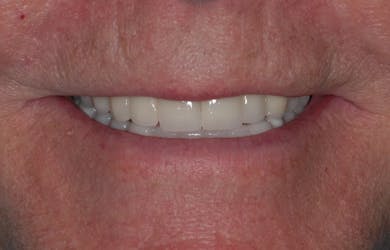 Full Mouth Rehabilitation Rehab