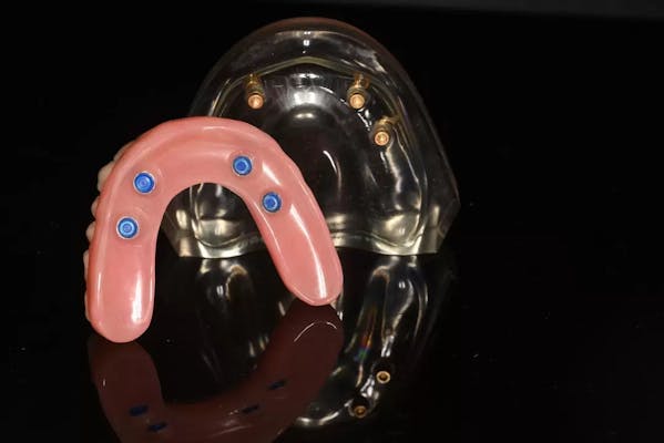 Locator Implant denture