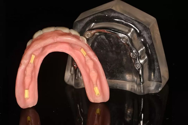 Bar Overdenture