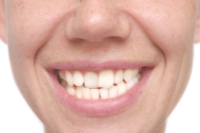 misaligned teeth
