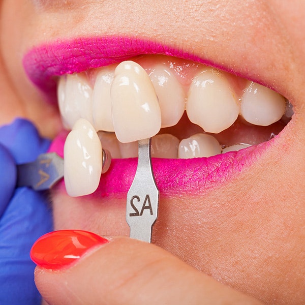 Porcelain Veneers