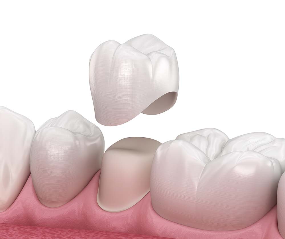 Illustration of a dental crown