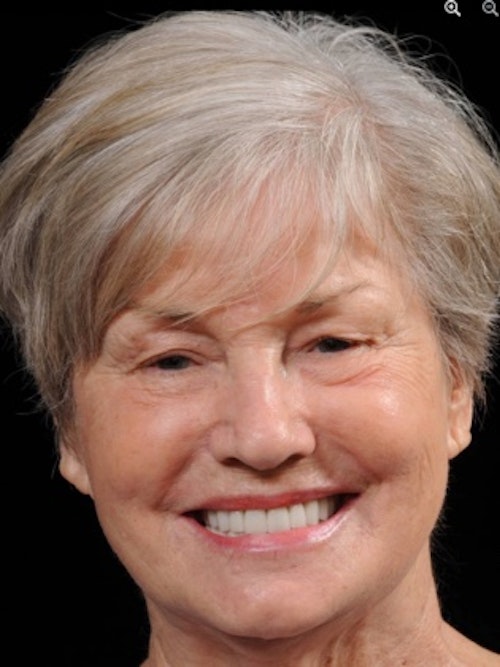 after patient received dental veneers