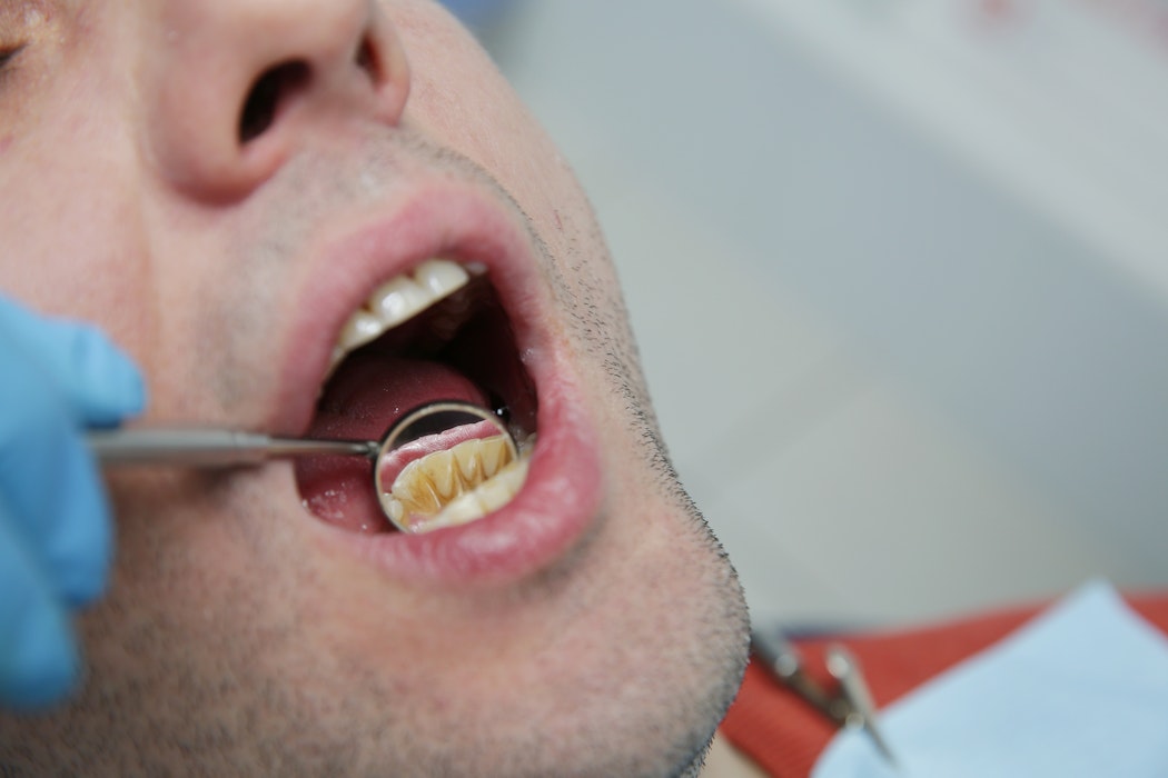 Close up of man's teeth during cleaning
