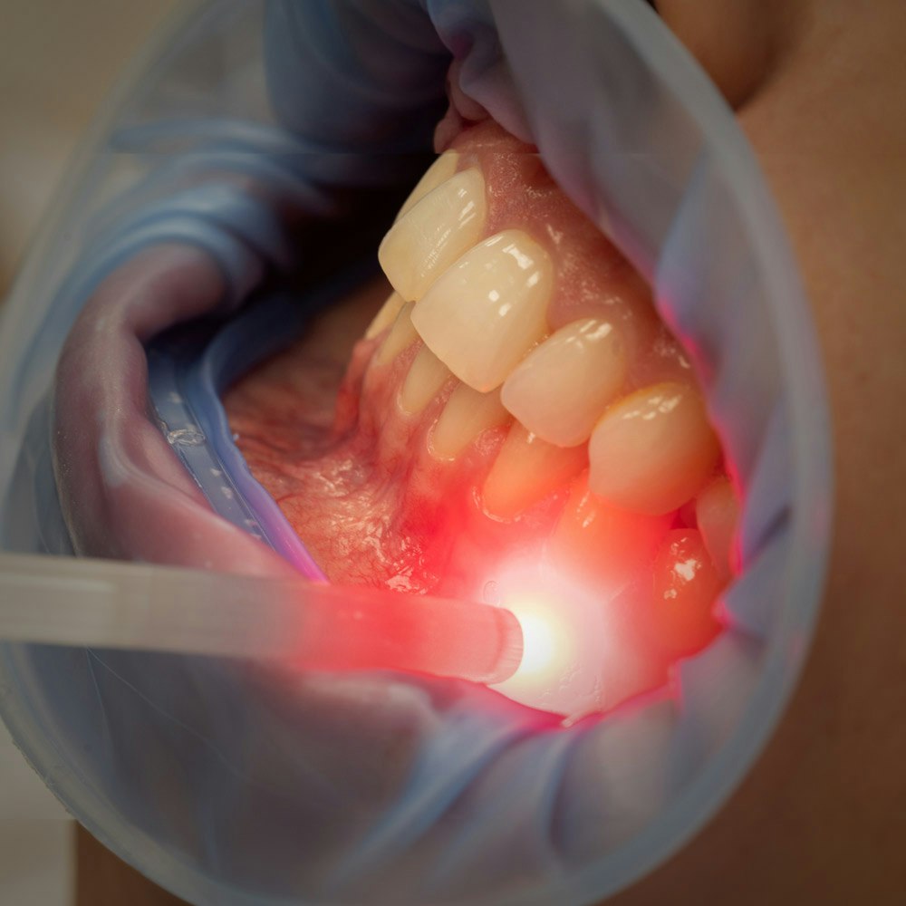 Laser dentistry