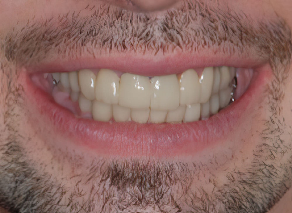 Dr. Ace Jovanovski's patient after Full Mouth Reconstruction
