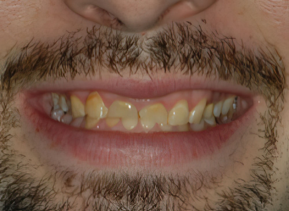 Dr. Ace Jovanovski's patient before Full Mouth Reconstruction