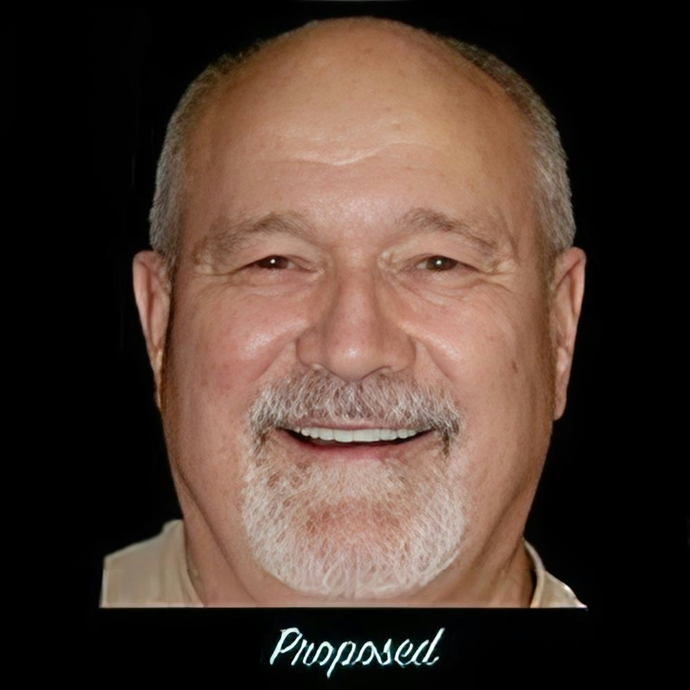 Proposed Smile Makeover based off of smile simulation technology